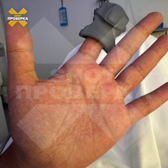 лихорадка денге